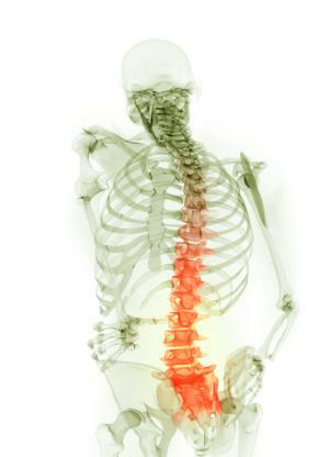 Ankylosing spondylitis