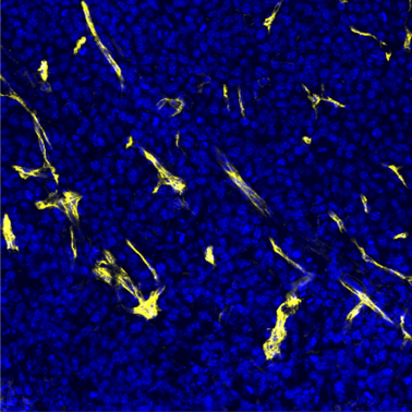 Blood vessels within a melanoma tumour