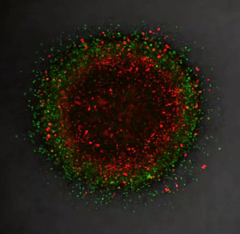 3D melanoma model helps explain therapy evasion