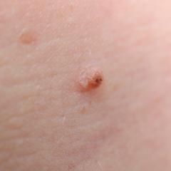 Pale melanomas masked by albino gene