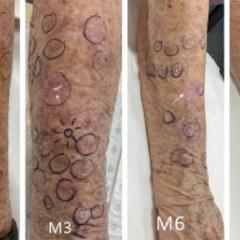Cancer immunotherapy treatment dramatically reduces sunspots