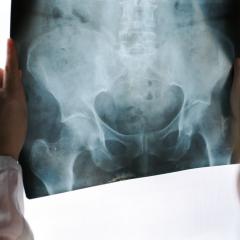 Bone x-ray