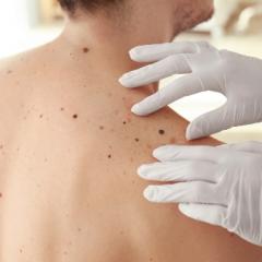 Potential genetic screening for aggressive melanoma