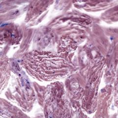 Cancer biopsy