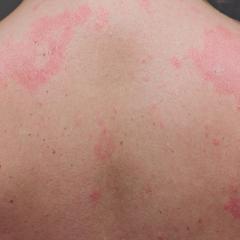 Skin rash