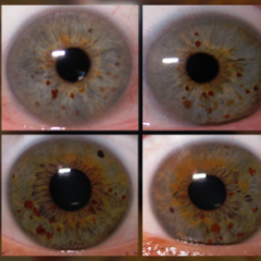Melanoma is in the eye of the beholder