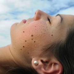 Moles on face