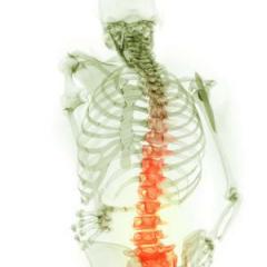 Ankylosing spondylitis