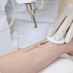 Tattoo removal