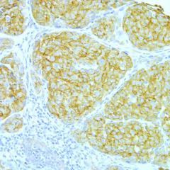 Molecule predicts patient’s ability to survive melanoma