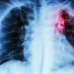Nature to lead fight against tuberculosis