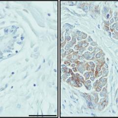 Breast cancer cells play survival trick
