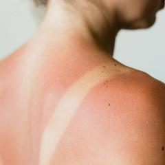 How to treat sunburn pain, according to experts